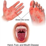 HFMD - Syndrom ruka – noha – ústa